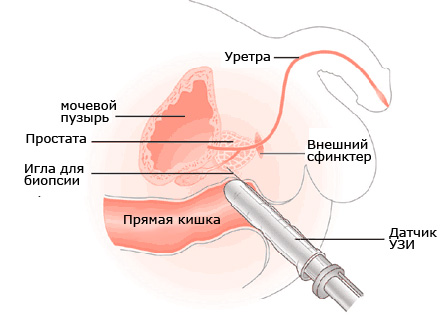 Ультразвуковая диагностика простаты4