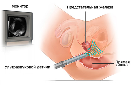 Ультразвуковая диагностика простаты6