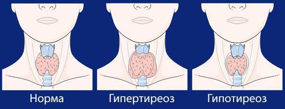 гистология щитовидной железы после операции