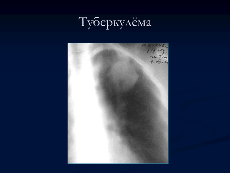 >Туберкулёма Туберкулёма лёгкого — относительно благоприятная форма туберкулёза, характеризующаяся казеозным фокусом, окружённым соединительнотканной капсулой
