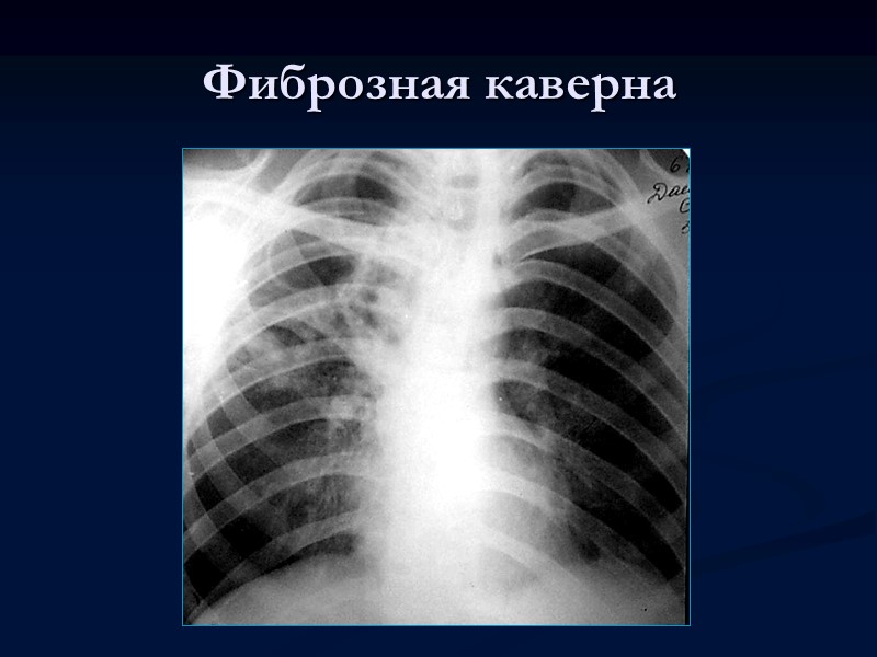 >Кавернозный туберкулез легких Кавернозный туберкулез легких характеризуется наличием сформированной полости распада