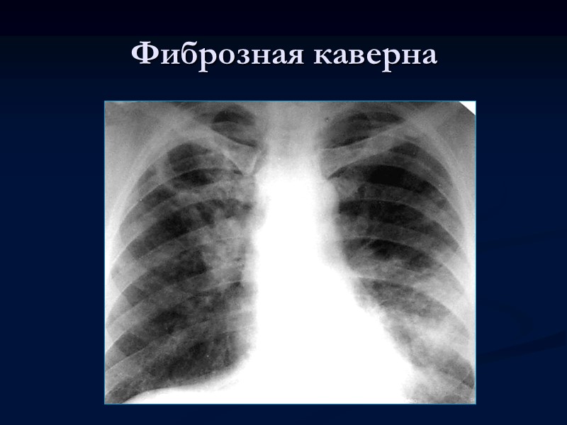 >Кавернозный туберкулез легких В зависимости от степени выраженности воспалительных изменений в