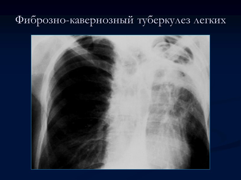 >Фиброзно-кавернозный туберкулез легких Фиброзно-кавернозный туберкулез легких характеризуется наличием фиброзной каверны, развитием фиброзных изменений в