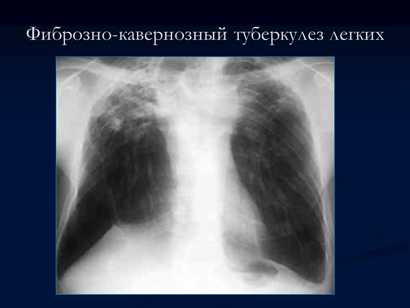 >Фиброзно-кавернозный туберкулез легких Различают три клинических варианта течения фиброзно-кавернозного туберкулеза легких: Ограниченный и