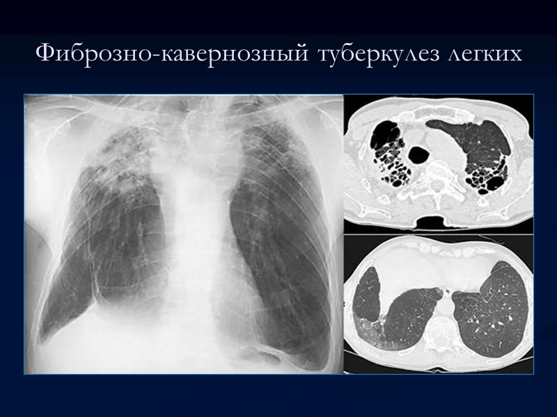 >Фиброзно-кавернозный туберкулез легких Фиброзно-кавернозный туберкулез легких. Обзорный снимок