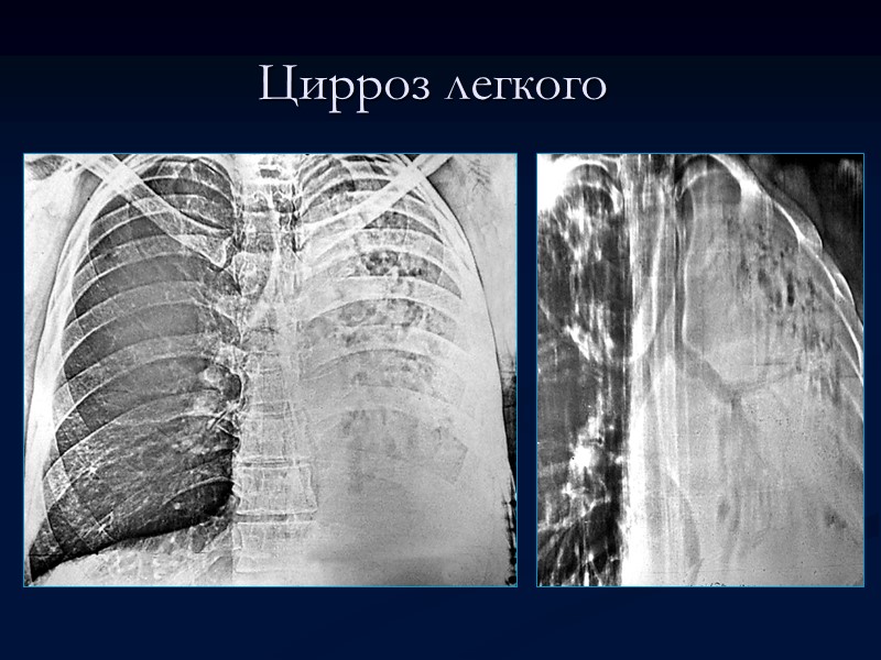 >Цирроз легкого Рентгенологическая картина сходна с изменениями при фиброзно-кавернозном туберкулезе, следствием которого