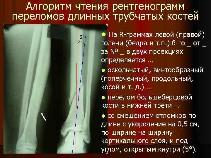 Алгоритм чтения рентгенограмм переломов длинных трубчатых костей 5° l На R-граммах левой (правой) голени