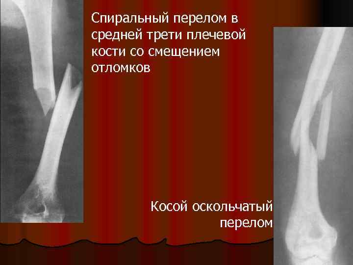Спиральный перелом в средней трети плечевой кости со смещением отломков Косой оскольчатый перелом 