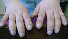 Пальцы в виде «барабанных палочек» с ногтями в виде «часовых стёкол» (ногти Гиппократа)